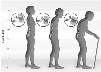 随着年龄的增长，椎体逐渐发生骨质疏松，身高逐渐缩短