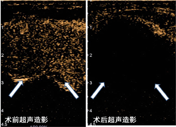 2原发甲旁亢术前超声造影可见肿块内高增强，说明病变生物活性很高，术后右图显示病变内没有强化，说明肿瘤已完全消融灭活.jpg