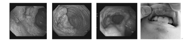 患者胃镜及溃疡检查.jpg